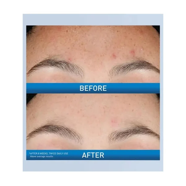 Rezultati korištenja Cerave Resurfacing Retinol seruma od 30ml